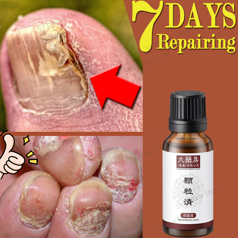 SY official store Bacteria Fungus Treatment Solution Anti fungal Removal Infection Cuticle Toe Nail Foot Protector Cream Nail Care Cuticle Care Manicure Pedicure